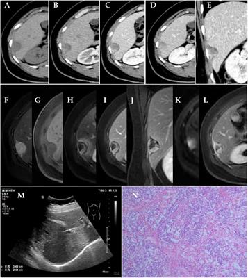 Case Report: Primary endodermal sinus tumor on the abdominal wall near the right liver: a diagnostic pitfall